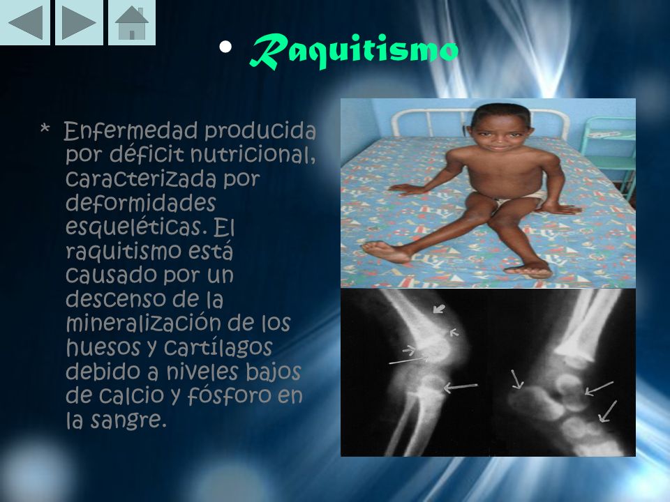 Resumen de la enfermedad raquitismo Resumen de la enfermedad raquitismo